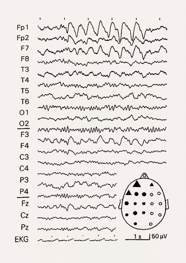 Abb.: Stepahn Zschocke, Klinische Elektroenzephalographie